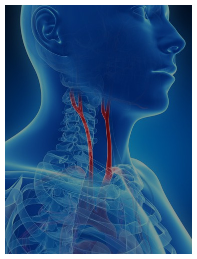 Carotid Aortal Diseases