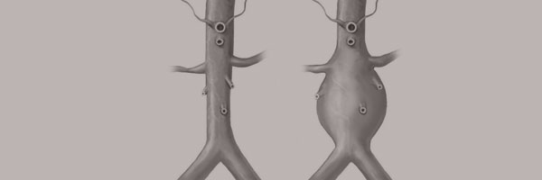Abdominal Aortic Aneurysm Abdomen Aortal Aneurism
