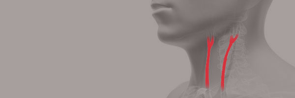 Carotid Artery Diseases Carotid Artery Diseases