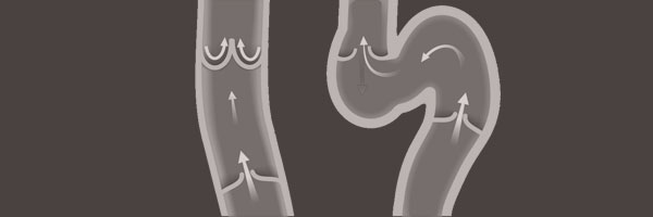 Varices Varices