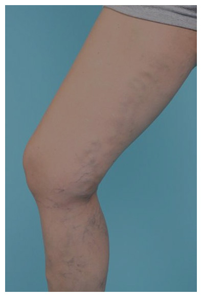 Varices